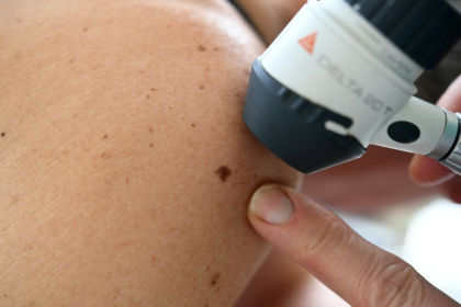 Une dermatologue examine un grain de beauté sur une patiente, le 22 mai 2019 à Quimper - Fred TANNEAU (AFP)